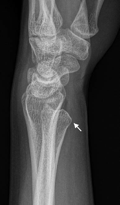 Left Wrist Radiograph Lateral View Showing Volar Displacement Of The