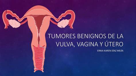 Tumores benignos de la vulva vagina y útero meder medicalnotes uDocz