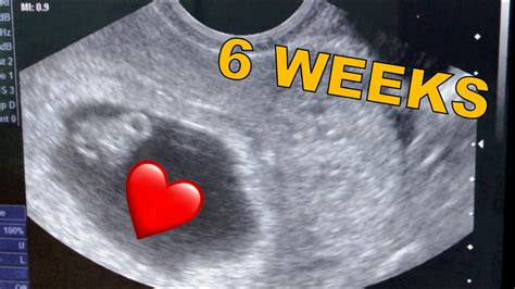 10 weeks 5 days pregnant