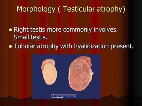 Progressive Testicular Atrophy In The Varicocele Individual Naturalmedico