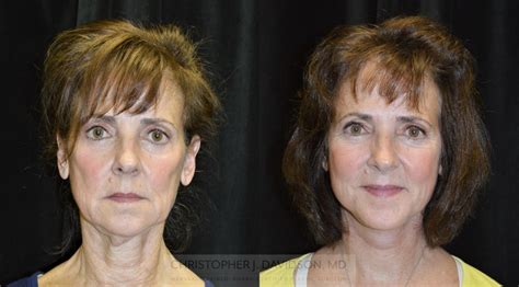 Get A Fresh Revitalized Look With Facial Rejuvenation Before And