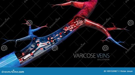 Varicose Veins Medical Illustration 27809292