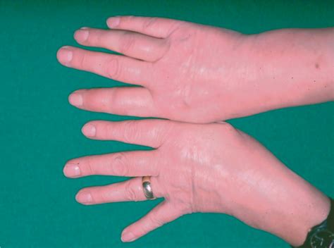 Die Rheumatische Hand Ursachen Diagnose Therapien Orthinform