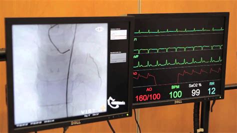 Cardiac Catheterisation Part 1 Left Coronary Youtube