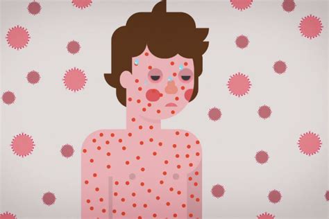 A Five Minute Cartoon Explains Measles In A Nutshell