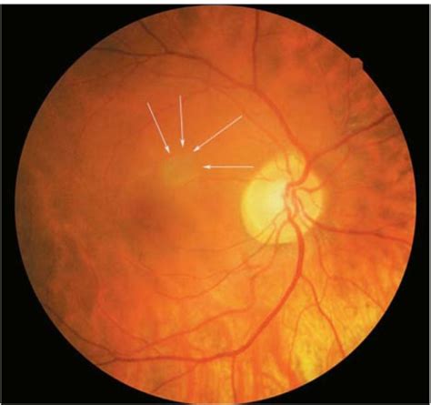 Color Fundus Photograph Of A Myopic Eye With Decreased Open I