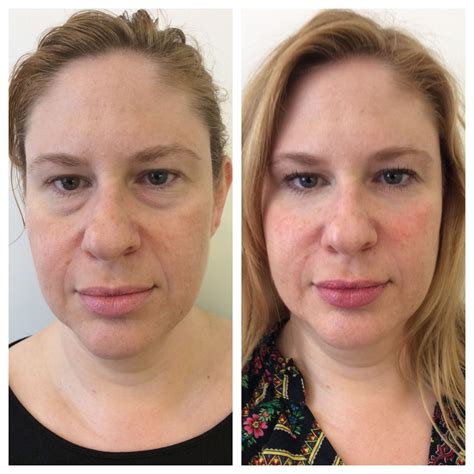 Non Surgical Under Eyes By Dr Rivkin Using Juvederm Under Eye Bags Juvederm Eye Bags