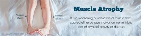 Muscle Atrophy Causes Symptoms Diagnosis Treatment And Prevention