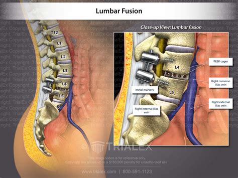 Lumbar Fusion Trial Exhibits Inc