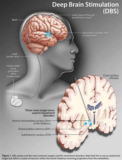 Deep Brain Stimulation HealthPlexus Net