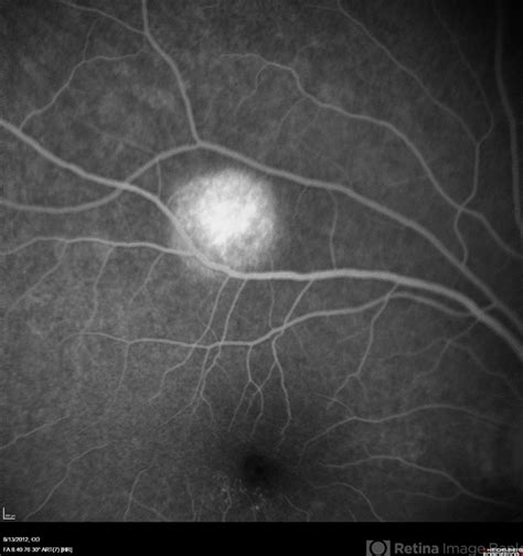 Unilateral Acute Idiopathic Maculopathy Fluorescein Angiography 2