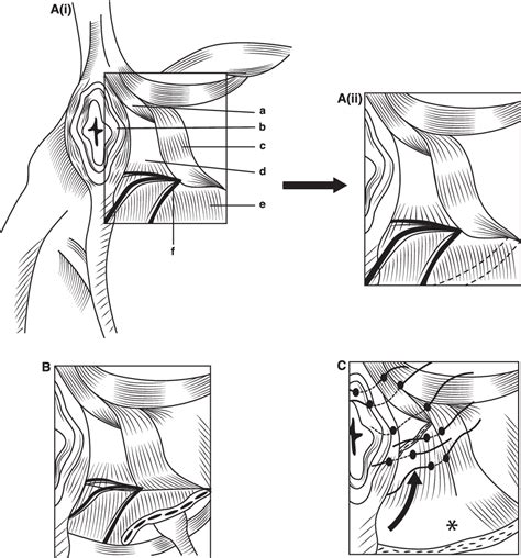 Figure 2 From A Review Of The Surgical Management Of Perineal Hernias