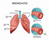 How Do Doctors Test For Pneumonia Images