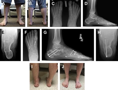 Overcorrected Flatfoot Reconstruction Foot And Ankle Clinics