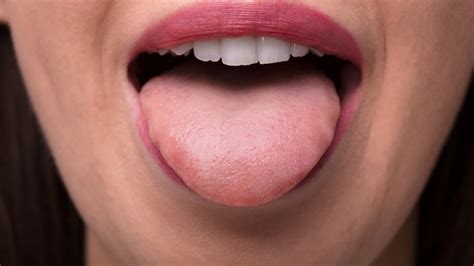 Grzybica Jamy Ustnej Objawy Przyczyny Czynniki Ryzyka Leczenie