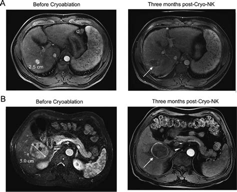 Mri Images Of 2 Representative Cases Achieved Cr At Three Months