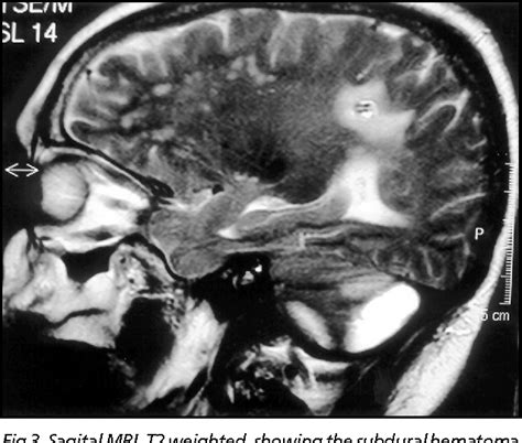 Figure 3 From Chronic Subdural Hematoma Of The Posterior Fossa