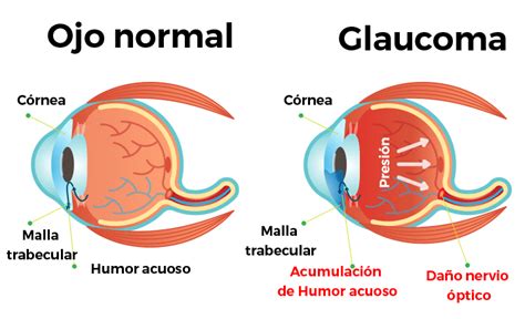 Detecci N Temprana Del Glaucoma En La Paz El Alto Bolivia Cl Nica