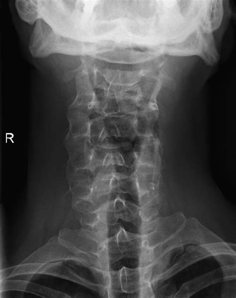 Cervical Spine Scoliosis Does Anybody Have This Rscoliosis