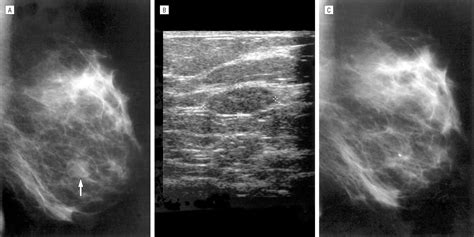 Diagnosis And Treatment Of Breast Fibroadenomas By Ultrasound Guided Vacuum Assisted Biopsy
