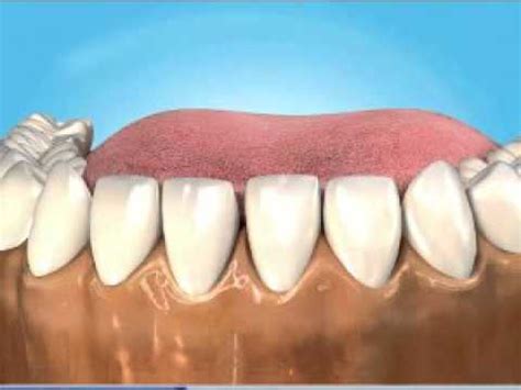 How does a tooth splint work. Splinting - loose teeth - YouTube