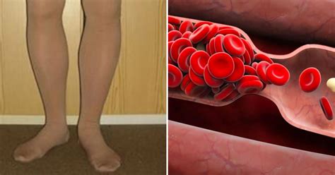 Your Body Warns You Before A Blood Clot 8 Hidden Signs You Should