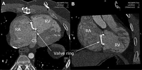 Cavotricuspid Isthmus Ablation Using Multimodality Imaging In Ebstein
