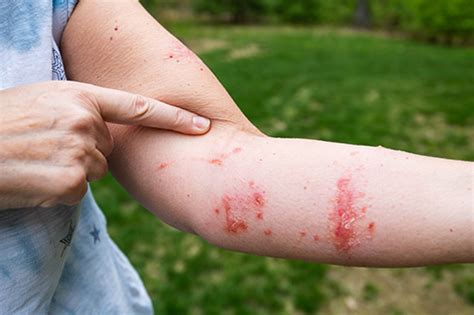 Ask The Doctor Relieving Poison Ivy Rash Lexington Medical Center