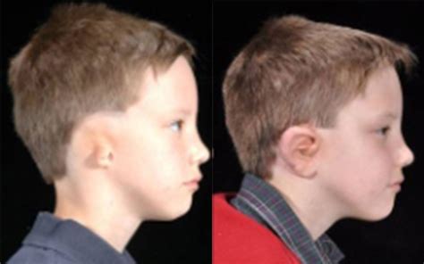 Ear Deformitiesmicrotia Before And After Pictures Dallas Plano Tx