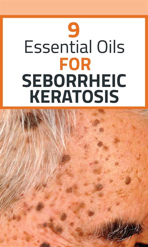 Essential Oils For Keratosis 23 Essential Oils For Skin Conditions