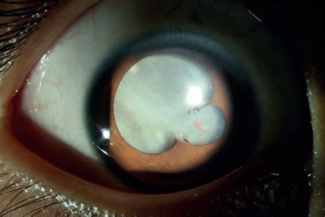 Ocular Toxocariasis Presenting As Leukocoria The Lancet Infectious