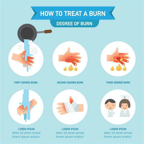 How To Treat A Burn Infographic Vector Illustration Vector Art