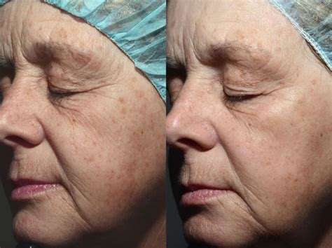 Laser Facial Before And After Emerge Fractional Laser Results