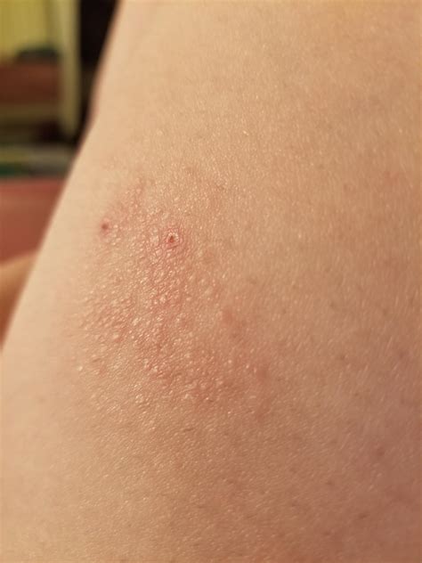Help What Do You Guys Think This Rash On My Thigh Could Be It Started