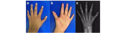 A Small Hands With Pointed Fingers Brachydactyly Bilateral Fifth