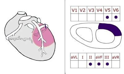 Elektrokardiogramm) handelt es sich um die untersuchung der. Infarkt 4