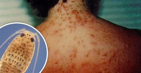 Warning Sea Lice Are Stinging Swimmers Causing Violent Rash In Popular