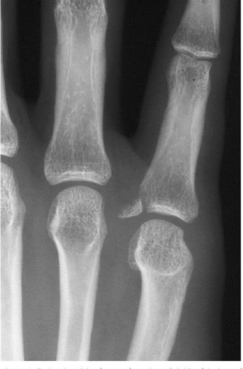 Figure 1 From Avulsion Fractures From The Base Of The Proximal