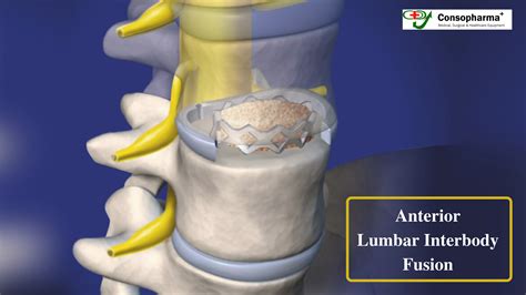 Anterior Lumbar Interbody Fusion The Best Treatment For Disc Problems