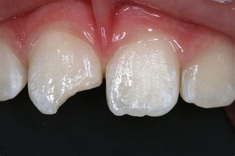 Tooth Filling Before And After