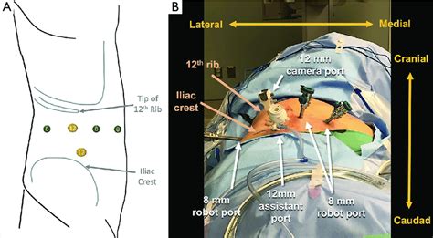 Port Placement For Retroperitoneoscopic Robotic Partial Nephrectomy
