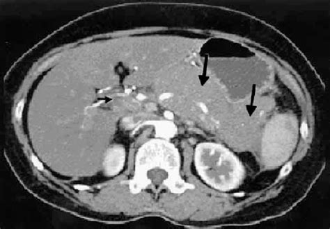 Ct Scan Showing Diffuse Homogenous Enlargement Of Pancreatic Parenchyma