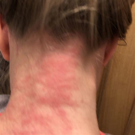 Allergic Reaction Details In Comments Raskdoctorsmeeee