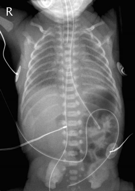 Nhsggc Umbilical Catheters