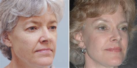 Before And After Ponytail Facelift 25 Gallery Los Angeles Ca Kao