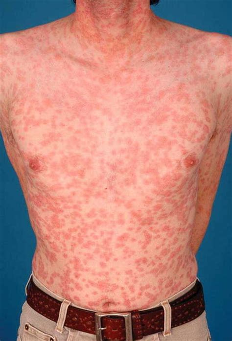 Healthoolsecondary Syphilis Rash Pictures Atlas Of Rashes Associated