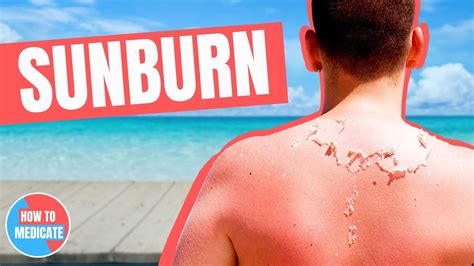 How To Treat A Sunburn Doctor Explains Youtube