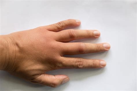 Causes Of Swollen Hands Medication Junction