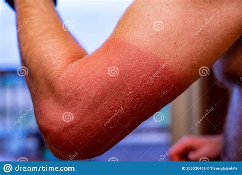 Arm With Visible Red Sunburn Caused By Wearing A Shirt Stock Image