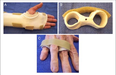 Figure 1 From Splintage In The Treatment Of Sagittal Band Incompetence